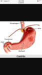 Ulcera/Gastritis/Colitis